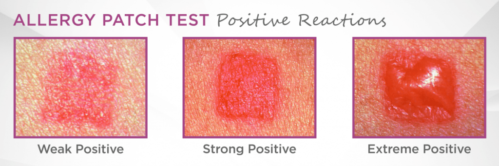 Do you get results immediately after allergy test?